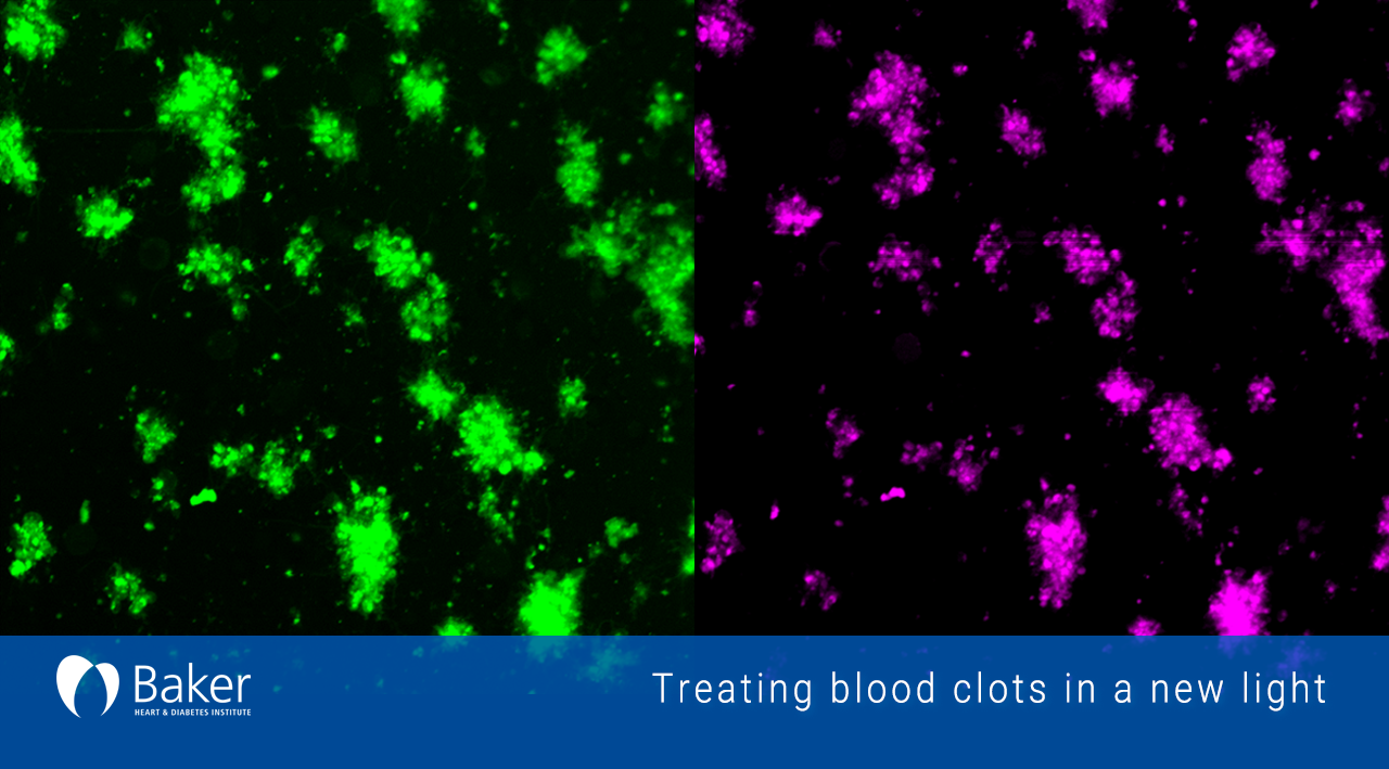Targeted photothermal treatment for blood clots shows promise