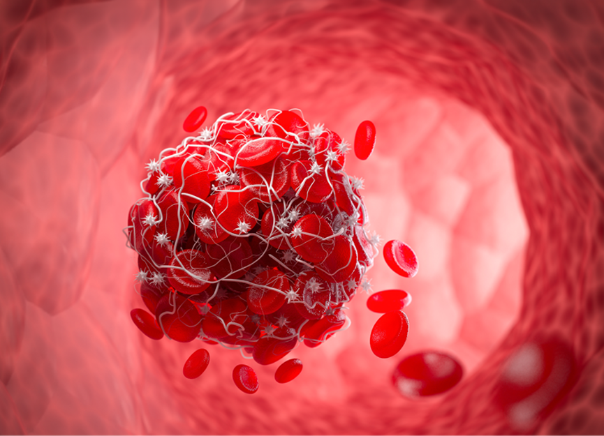 Atherothrombosis blood clot