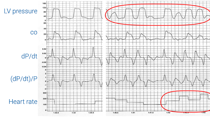 Pressure trace of the left ventricle